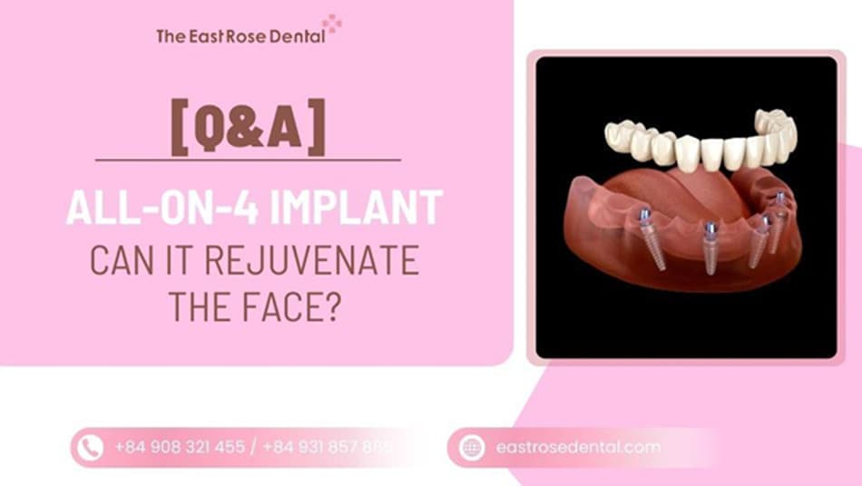 Can All-on-4 Full-Arch Implants Transform Facial Appearance and Restore Youthfulness?