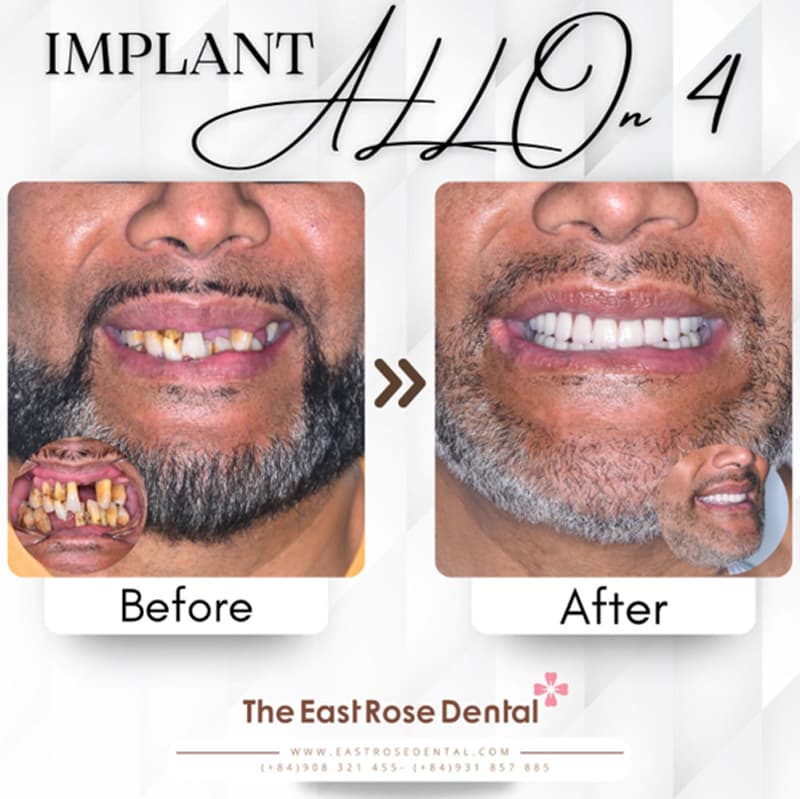 All-on-4 restoration enhances your smile, helping you look more youthful