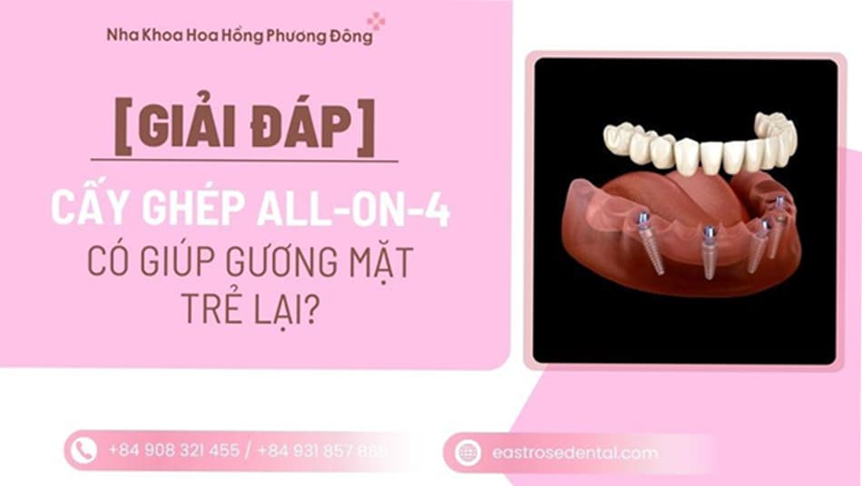 Cấy ghép All-on-4 toàn hàm có giúp thay đổi khuôn mặt và độ trẻ trung không?