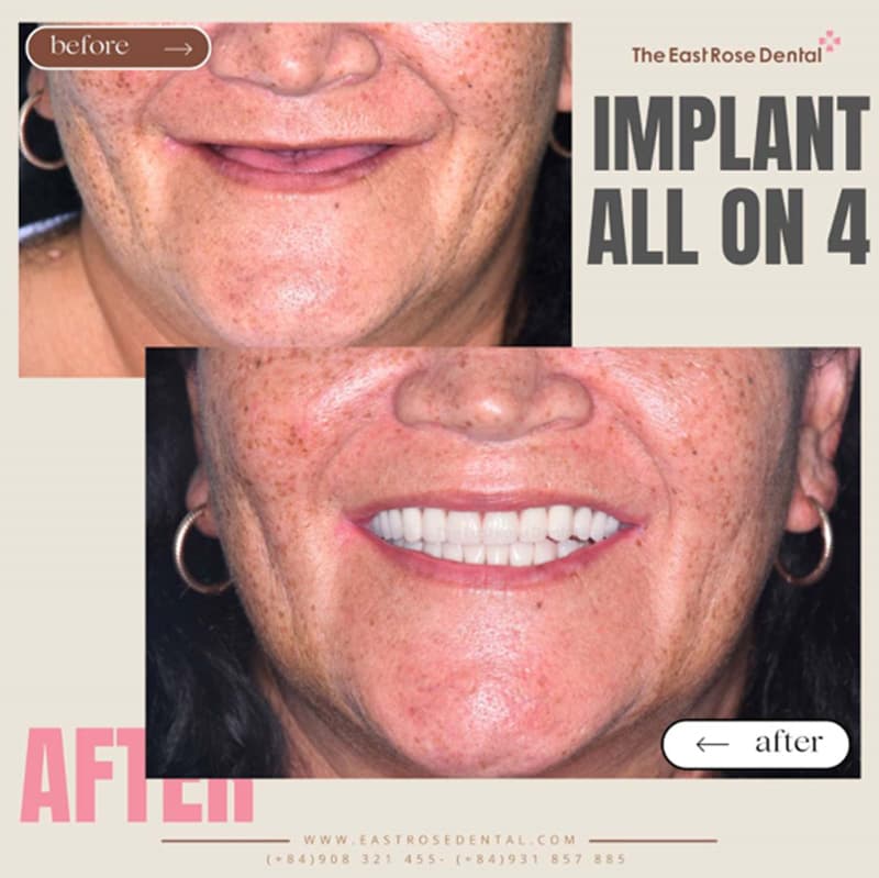 All-on-4 restoration results at The East Rose Dental