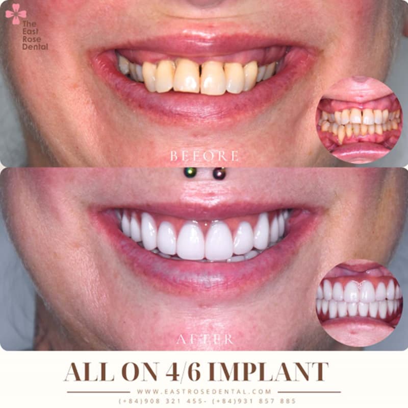 All-on-4 restoration results at The East Rose Dental