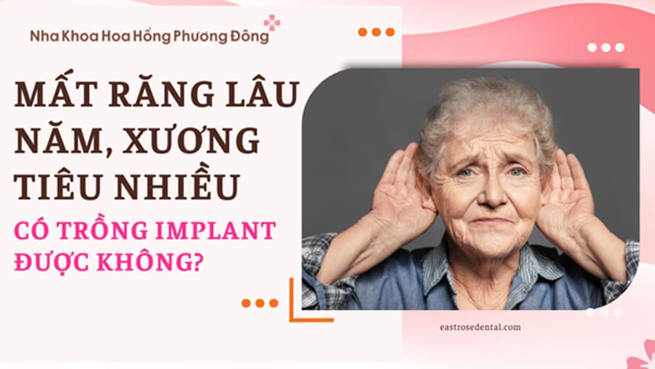 Mất răng lâu năm, tiêu xương nhiều có trồng implant được không?