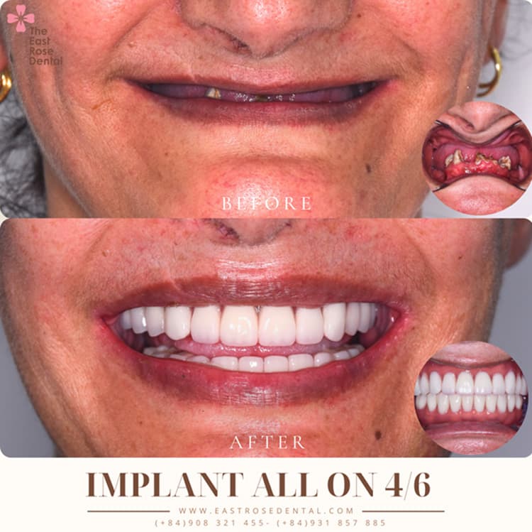 Case implant all on 4/6 tại Nha Khoa Hoa Hồng Phương Đông