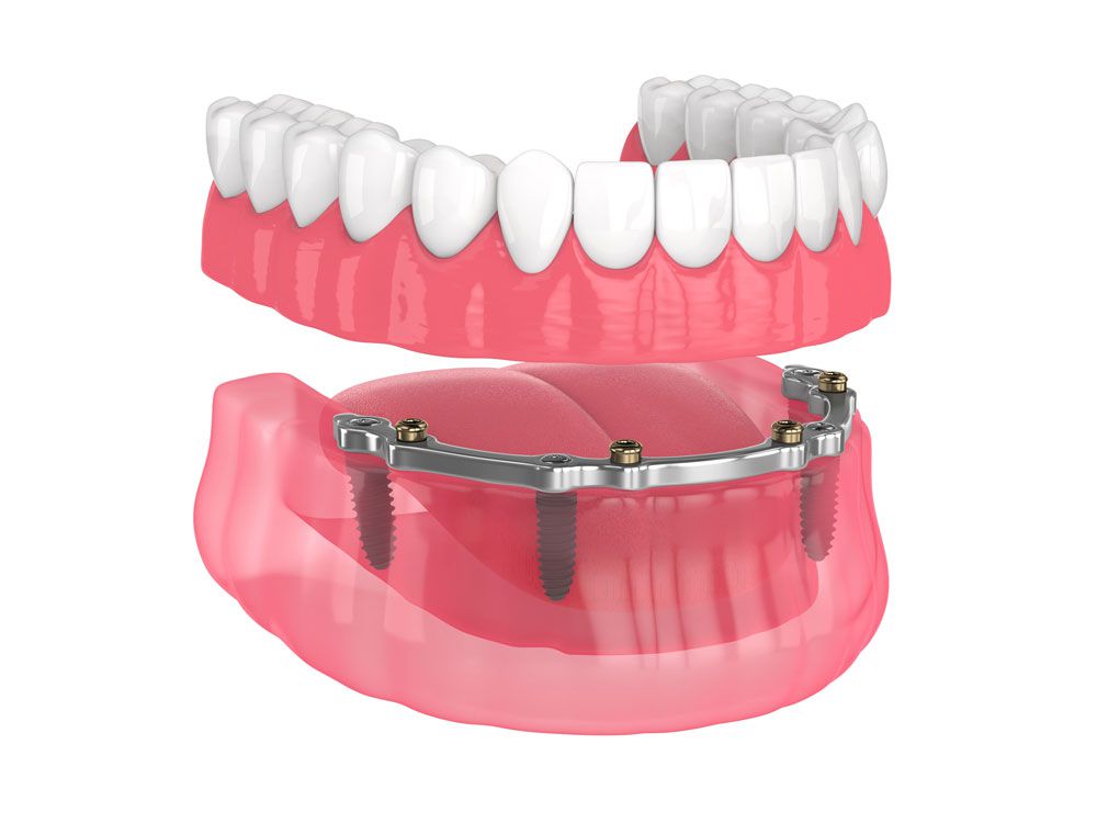 Chi phí trồng răng cố định toàn hàm implant all on 4 bao nhiêu ?