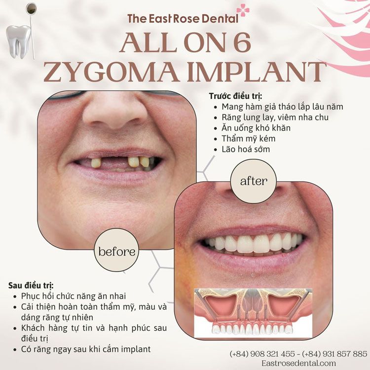 All on 6 implant Zygoma