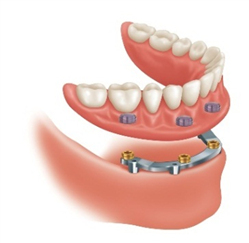 3 Implants, a customized metal bar, an over denture ( RP4)