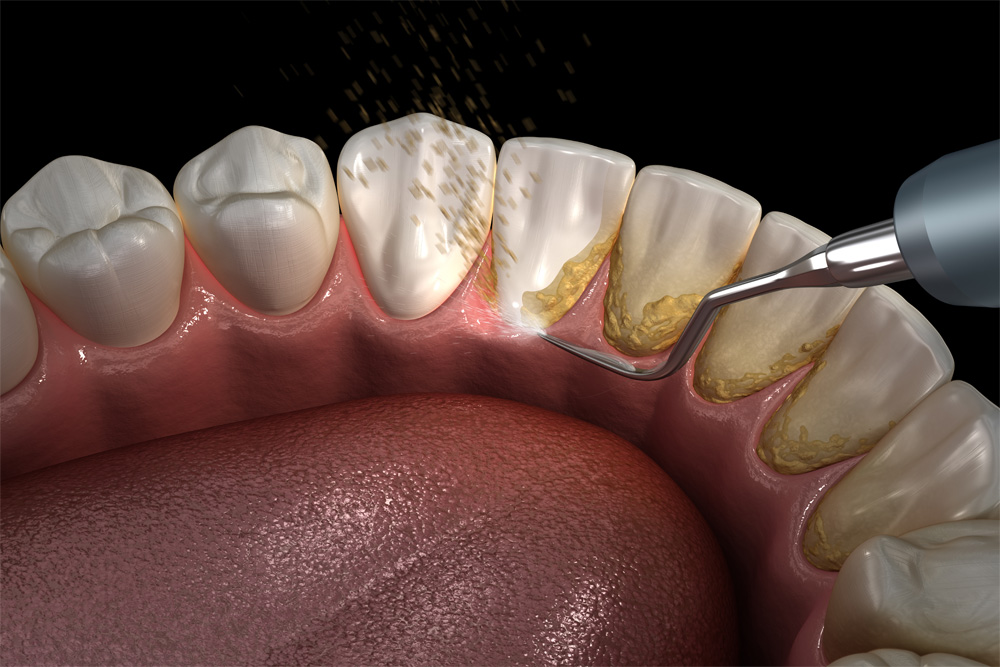 Cạo vôi răng thường xuyên nhằm ngăn ngừa bệnh viêm nướu