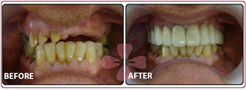 Implant + Zirconia