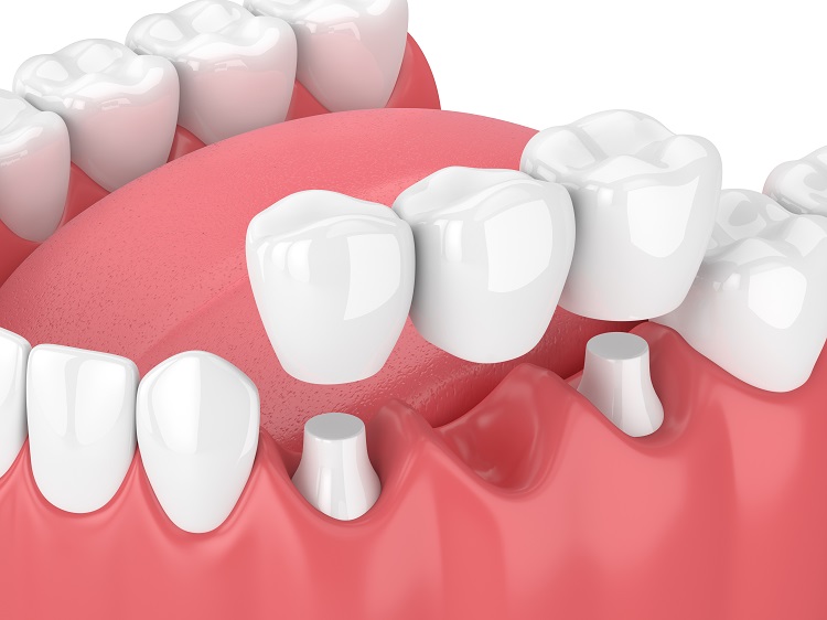 What is porcelain dental bridge? Choose the right type of porcelain bridge