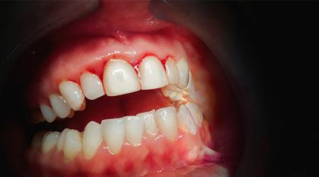 Bleeding Gum: Causes and Treatment