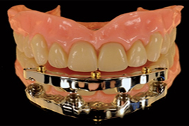 04 Implants + a Customized Titannium metal bar CAD/ CAM + 4 Balls Rhein 83 - Italy + an Over denture ( RP4)