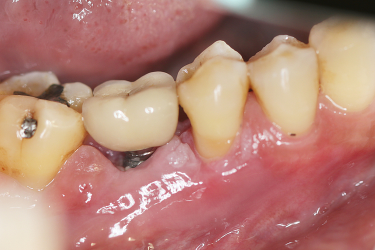 Kinh nghiệm làm răng implant: Implant có bị đào thải không?