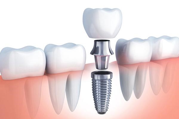 Cấy ghép răng implant có đau không?