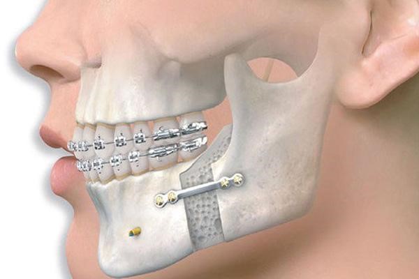 Is underbite jaw surgery painful? Answers from experts