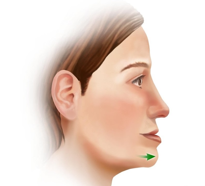 Is Underbite Jaw Surgery safe? How effective is it?