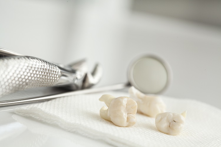 Vì sao cần nhổ răng khôn? Nhổ răng khôn có nguy hiểm không?
