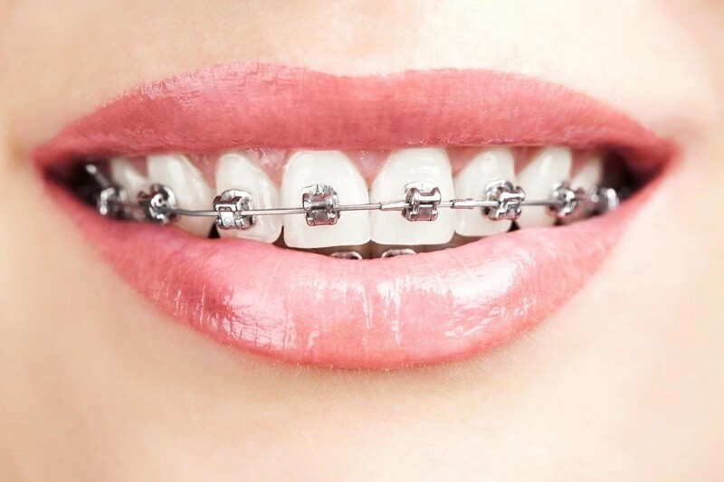 How many types of braces are there? Does it make teeth weaker?