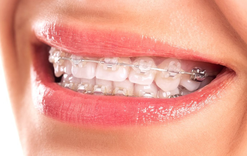 Are porcelain braces really as good as rumors?
