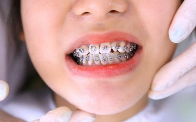 Niềng răng có đau không? Tìm hiểu quy trình niềng răng tại Eastrosedental