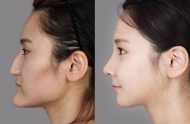 Long chin surgery method to bring a natural balanced chin shape