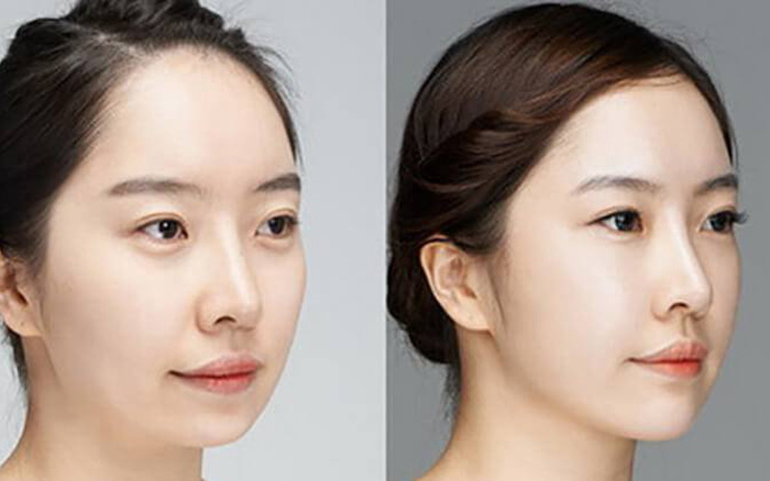 Overview of low chin surgery - an information guide for you