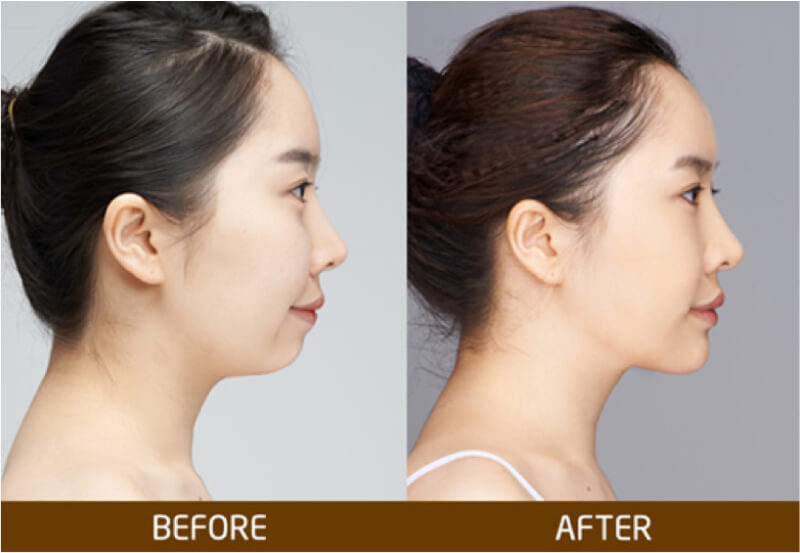 Exercises to help overcome a receding chin at home