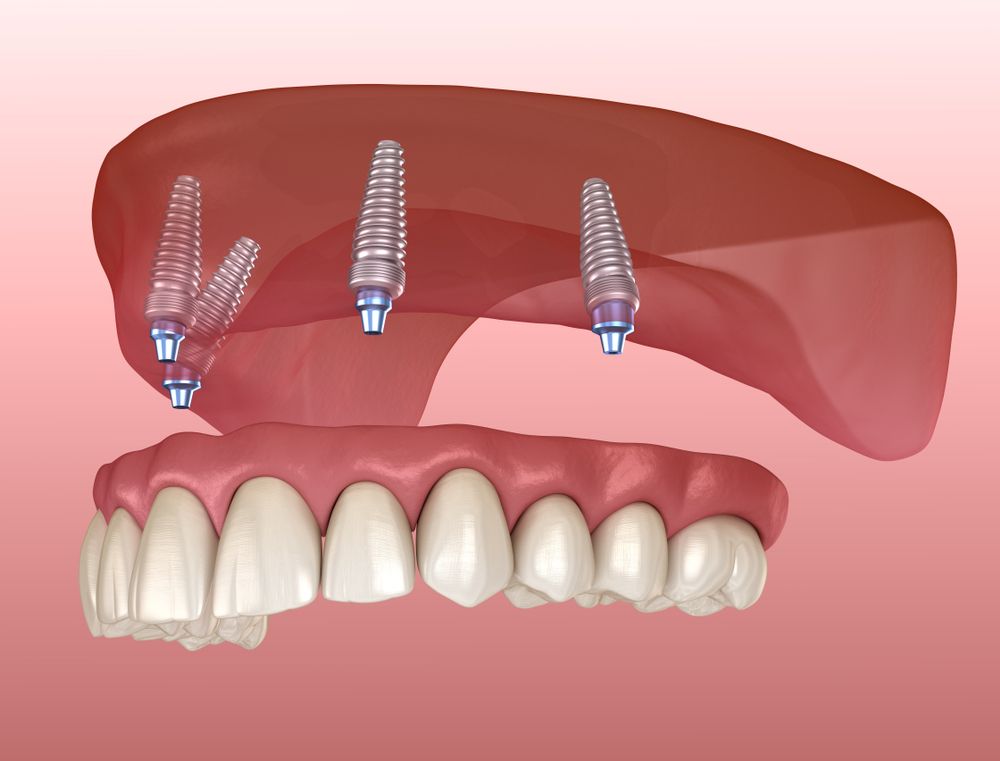 Phương pháp cấy Implant All on 4 sử dụng được bao lâu ? Có đảm bảo an toàn cho bệnh nhân không ?