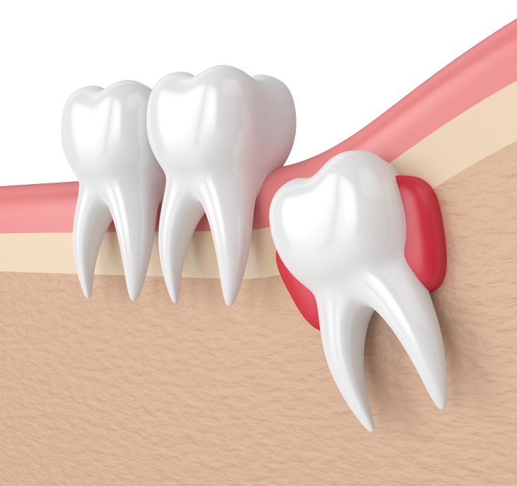How long does wisdom tooth pain last? When to get wisdom teeth removed?