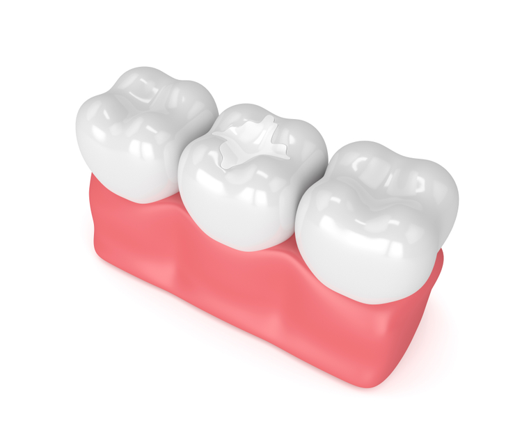 Những ưu điểm khi trám răng thẩm mỹ bằng composite