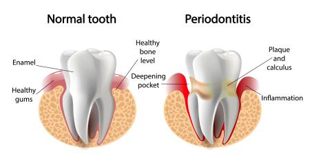 Periodontitis: Causes and Treatment